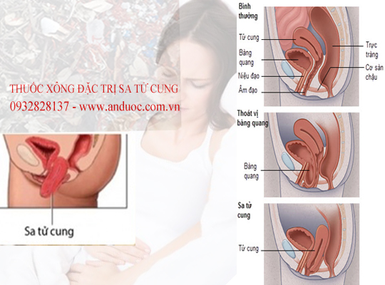 Triệu chứng bệnh sa tử cung và cách trị nhanh nhất